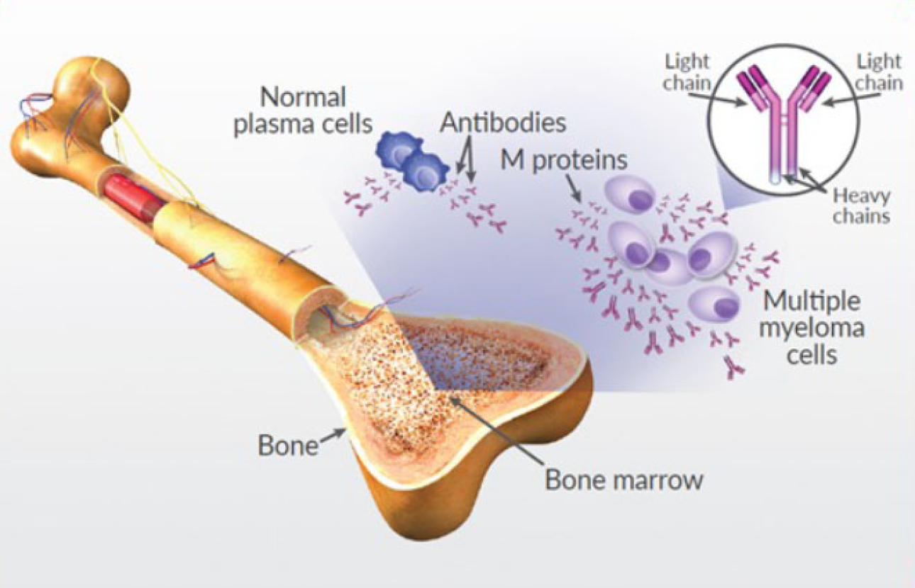 Multiple Myeloma